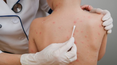 All about Chicken pox